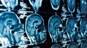 E' italiana la tecnologia che combatte Alzheimer e Parkinson